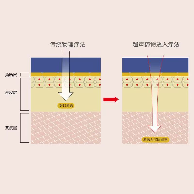 超聲藥物透入治療儀中醫(yī)定向透藥治療儀雙通道導(dǎo)藥儀透皮給藥儀